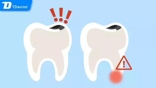 Bệnh sâu răng ăn vào tủy có nguy hiểm không?
