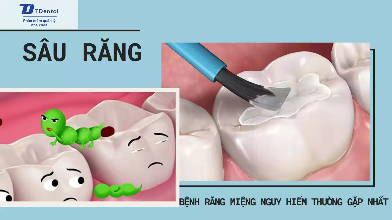 sâu răng - bệnh răng miệng nguy hiểm thường gặp