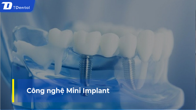 Công nghệ Mini Implant