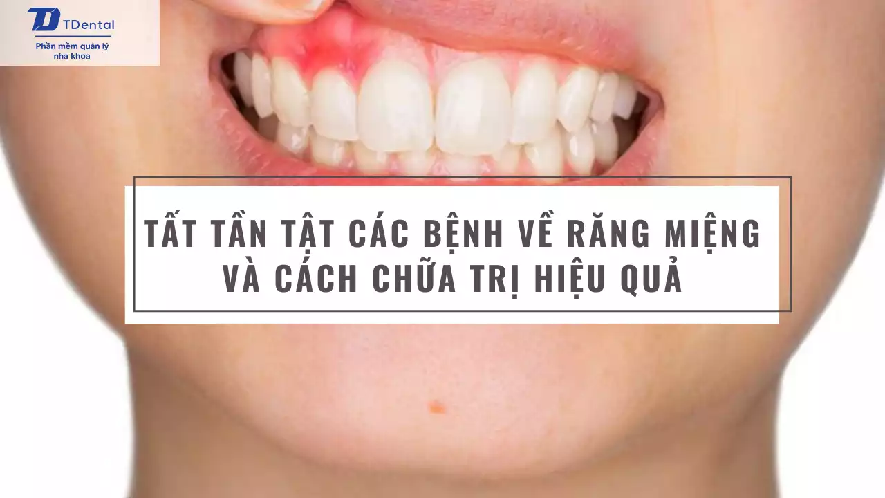 Ve Rang Tất tần tật các bệnh về răng miệng và cách chữa trị hiệu quả
